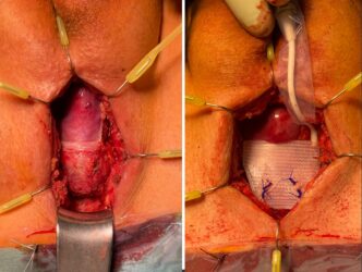 Perinealer Situs eines Patienten mit Revision nach primär nicht erfolgreicher ATOMS-Implantation: links: enferntes altes ATOMS, die Pseudokapsel bedeckt den penobulbären Harnröhrenübergang; rechts: das neue ATOMS-Kissen unterstützt unmittelbar den Bulbus urethrae.
