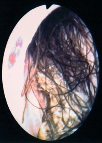 Abb. 1: Haartragende Harnröhre bei Urethroskopie.