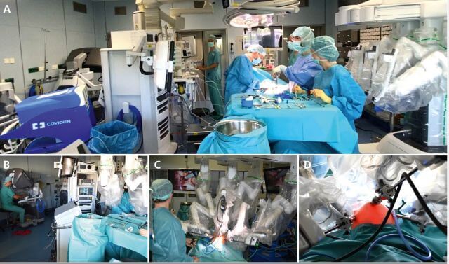 Abb. 1: Räumliches Setup für robotisch assistierte Kinderchirurgie. A–C) Typische Anordnung der Instrumente und des Roboters im kinderchirurgischen Operationssaal. D) Beispiel für die Trokarplazierung bei robotisch assistierter laparoskopischer Harnleiterneueinpflanzung nach Lich-Gregoire.