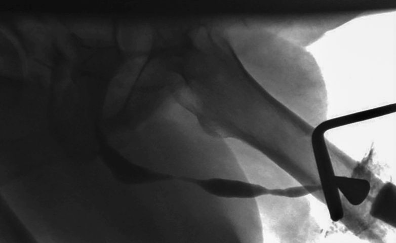 Abb. 2: Das Urethrogramm zeigt eine multilokuläre Striktur der Harnröhre.