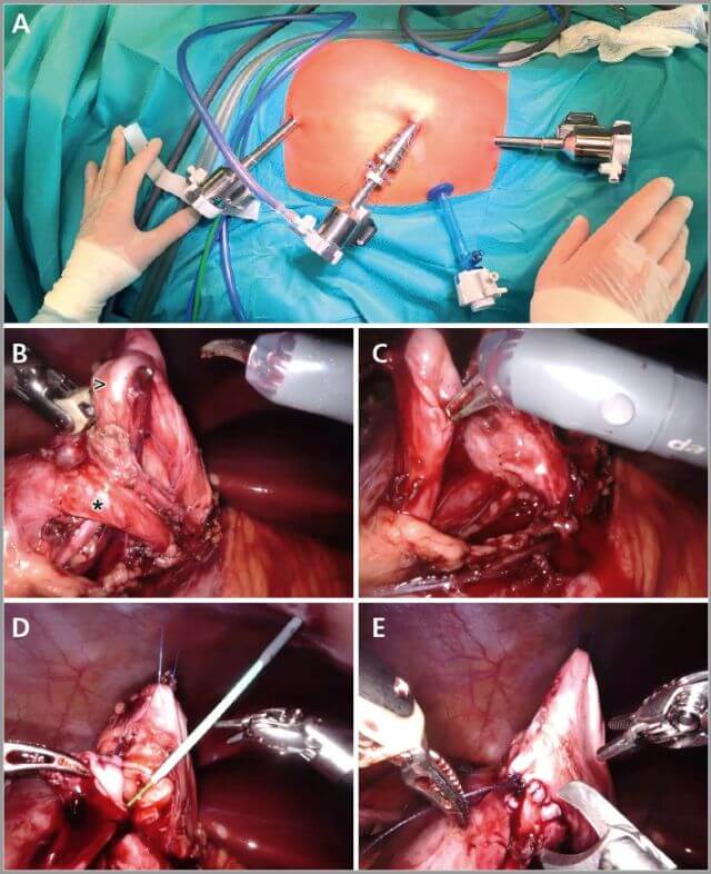 Abb.  2: Robotisch assistierte laparoskopische Pyeloplastik. A) Trokarpositionen. B) Präparation des Ureters; > = Ureter; * = Aberrierendes unteres Polgefäß. C) Spatulieren des Ureters vor der Anastomosierung an das Nierenbecken. D) Beginn der Anastomose und Einlage eines Doppel-J-Katheters in den Ureter bis in die Harnblase. E) Komplettierung der Anastomose.