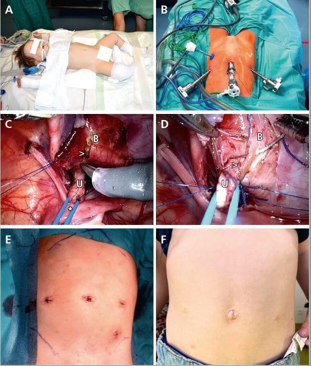 Abb. 3: Robotisch assistierte laparoskopsche Harnleiterneueinpflanzung nach Lich-Gregoire. A) Lagerung der Kinder. B) Trokarpositionen. C) Anschlingen des Ureters mit Vessel Loop, Detrusotomie; U = Ureter; B = Harnblase; * = Vessel Loop; > = Detrusotomie. D) Detrusorrhaphie. E) Postoperative Darstellung der Trokarstellen. F) Nach 3 Monaten.