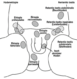 Maldeszensus testis