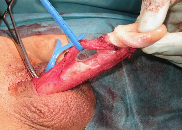 Abb. 2: Defekt der Tunica albuginea nach partieller Plaqueexzision.