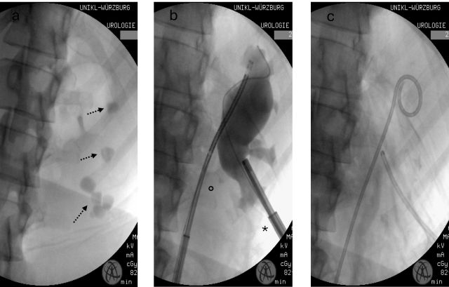 Abb. 3: intraoperative Röntgenbilder: a) Klassische ECIRS-Indikation: ausgedehnte Steinlast in mehrern Endkelchen der linken Niere, die vorauss. nicht mittels alleiniger Mini-PNL saniert werden kann b) ECIRS via flex. URS und mini-PNL* c) steinfreie Niere mit einliegender PCN und Mono-J.