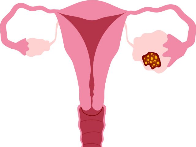 Illustration einer Eierstockerkrankung. Eierstockkrebs