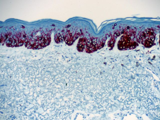 Melanom in situ der Haut. Die malignen Zellen erscheinen in dieser Färbung rot. Mikroskopische Aufnahme