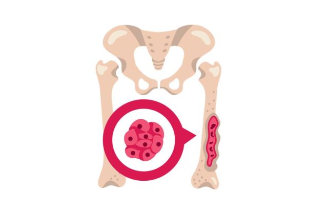 Krebszellen im Knochenmark des Oberschnekknochens