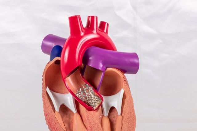Modell eines menschlichen Herzens mit implantierter TAVI-Klappe, Darstellung des medizinischen Eingriffs in Deutschland