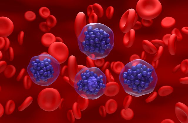 Diffuses großzelliges B-Zell-Lymphom (DLBCL) – isometrische Ansicht, 3D-Illustration