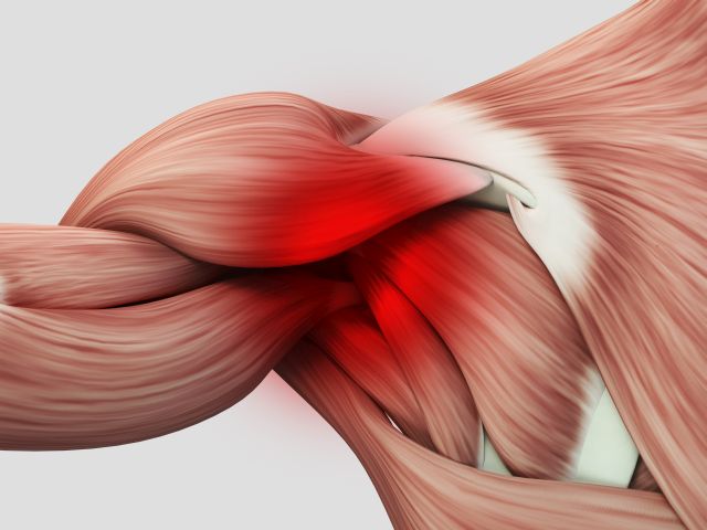 3D-Illustration von Muskeln mit einer roten Markierung zur Symbolisierung vom Rhabdomyosarkom, das vom Muskelgewebe ausgeht.