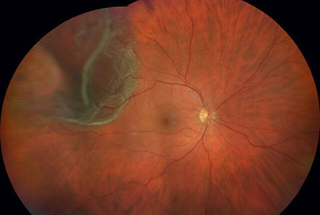 Fundusfoto Netzhaut nach Buckelchirurgie
