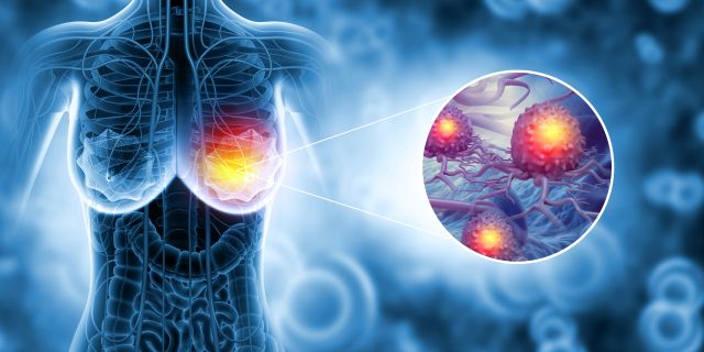 3D-Illustration von Krebs der weiblichen Brust
