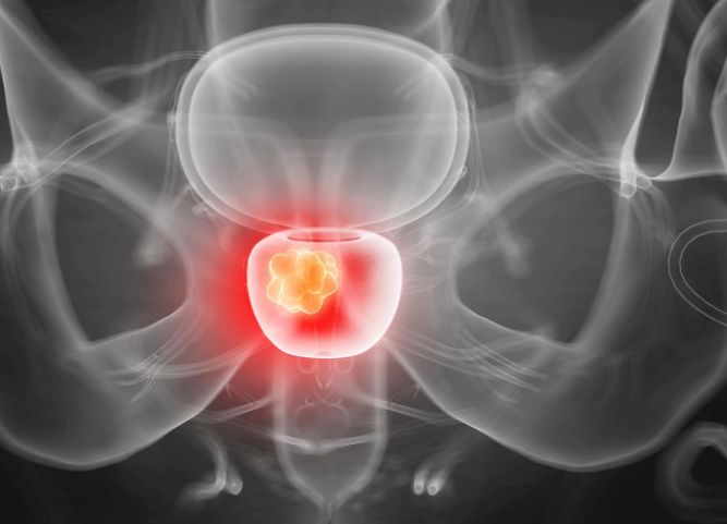 Illustration Prostatakrebs