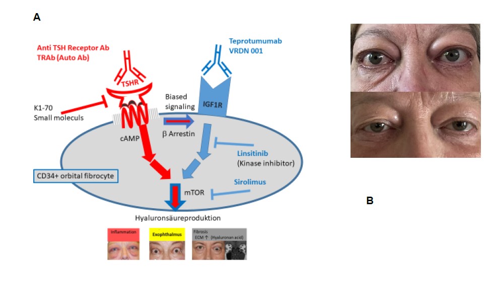 Schematische Darstellung der Wirkungsweise des IGF1R Blockers und Fotos einer Basedow-Patientin vor- und nach der Behandlung
