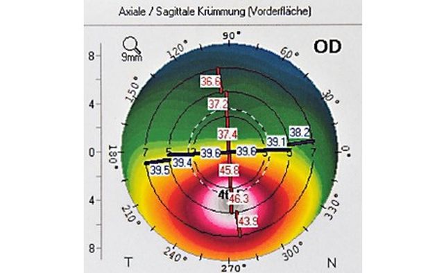 Topografische Aufnahme eines ausgeprägten Keratokonus