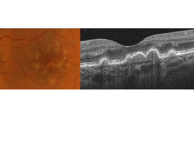 Farbfundusfotografie und OCT eines Auges