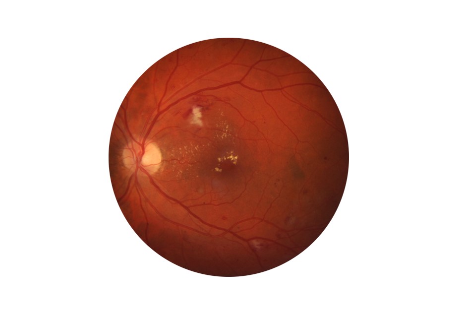 Fundusaufnahme der Netzhaut