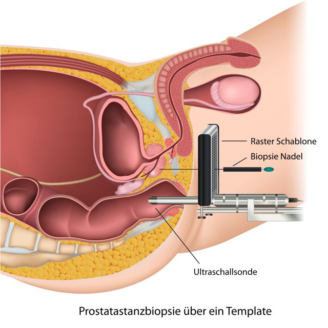 Prostatastanzbiopsien