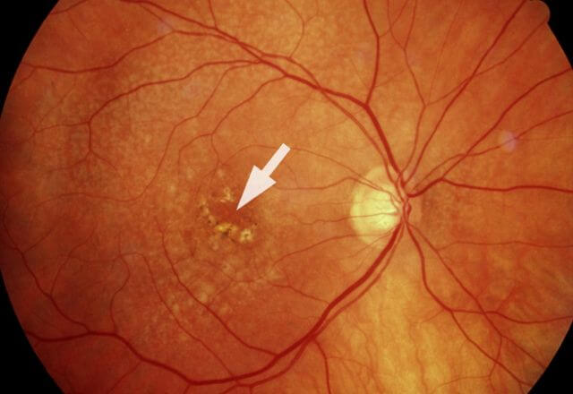 Großaufnahme Auge mit trockener altersabhängige Makuladegeneration