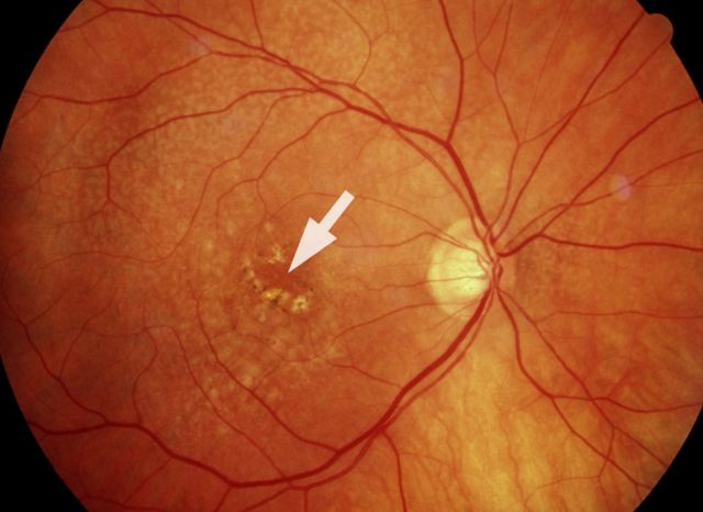 Trockene altersabhängige Makuladegeneration