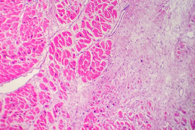 Mikroskopische Aufnahme von Herzgewebe mit Fibrosierung, relevant für die Herzinfarkt-Therapie.