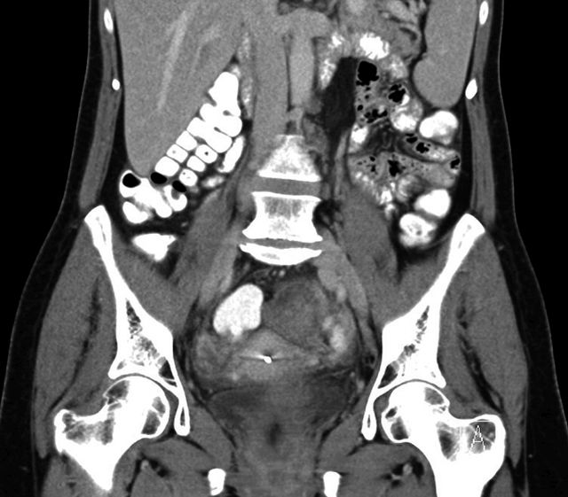 CT-Aufnahme des Abdomens bei laproskopischer Granulosazelltumor-Entfernung.