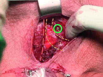 Perinealer Situs 1 = Ramus inferior
ossis pubis; 2 = mobilisierter Bulbus
urethrae; 3 = optimaler Punktionsort
für den Tunnelierer am mediodorsalen
Winkel des Foramen obturatorium.
