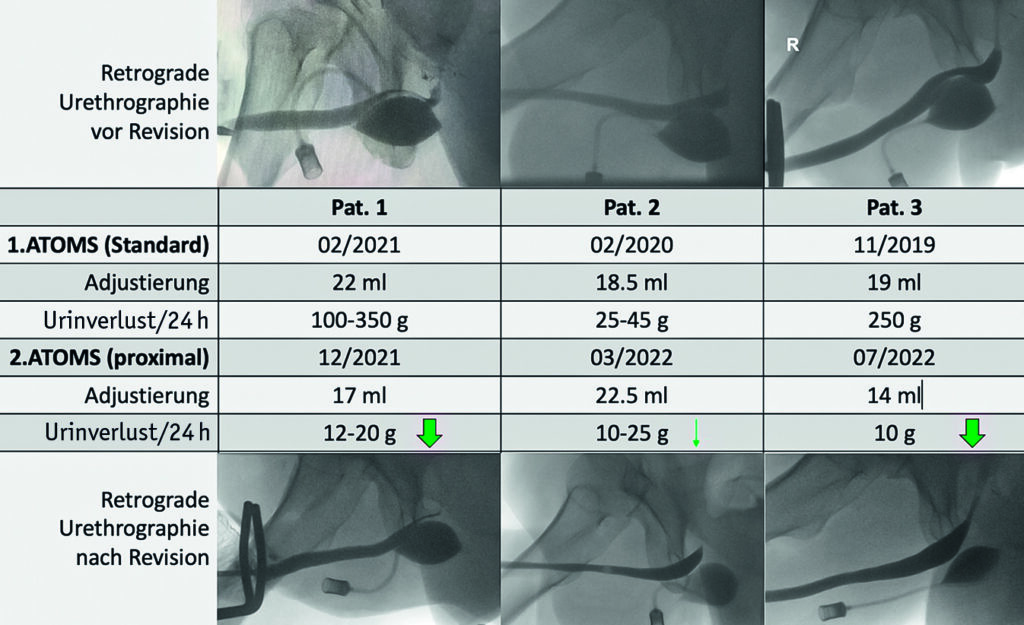 Vergleich retrograder Urethrographien sowie der Kontinenzsituation vor
und nach Revision mit Anwendung der proximalen ATOMS-Implantationstechnik.