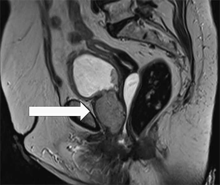 Abb. 1: MRT (sagittal) des Beckens 01/2022 mit ausgedehnter, zirkulär infiltrierendem Urethra-Tumor auf gesamter Länge mit Blasenhals-Infiltration.