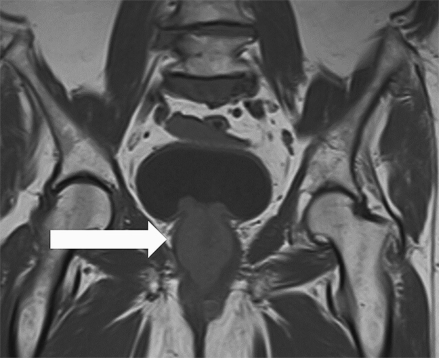 Abb. 2: MRT (coronar) des Beckens 01/2022 mit ausgedehnter, zirkulär infiltrierendem Urethra-Tumor auf gesamter Länge mit Blasenhals-Infiltration.
