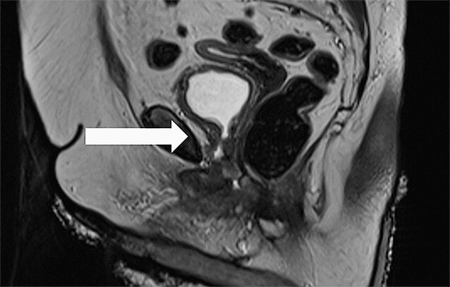 Abb. 3: MRT (sagittal) des Beckens 03/2022 mit im proximalen Bereich der Urethra massiv regredienter Raumforderung mit nur noch minimalem Restbefund.