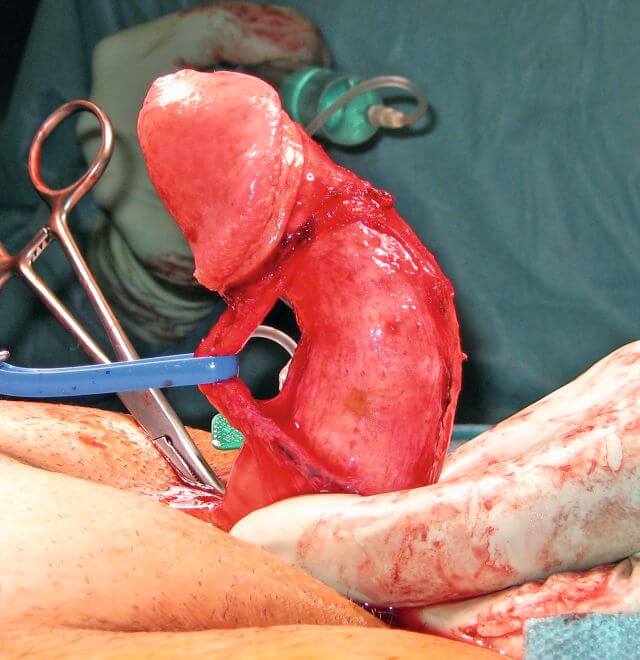 Abb 1: Penisdeviation nach dorsal 80° während artifizieller Erektion (intraoperativer Aspekt nach Präparation und Mobilisierung des neurovaskulären Bündels).