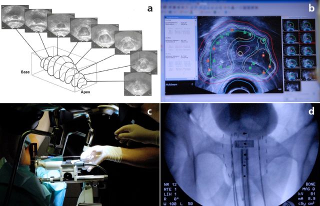 Abb. 1: Schematische Vorgehensweise der Volumenstudie der Prostata in