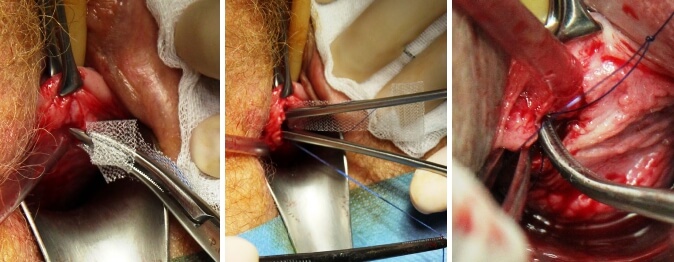 Einbringen des Bandes