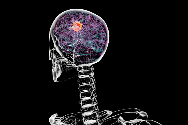 Gehirntumor, 3D-Illustratio