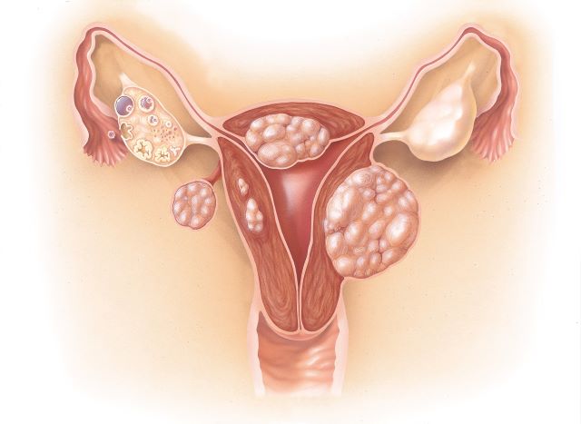 Medizinische Illustration eines Ovarialkarzinoms mit Tumoren in den Eierstöcken und der Gebärmutter.