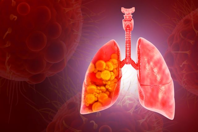 Illustration der menschlichen Lunge mit Tumoren, die auf Lungenkrebs hinweisen, vor einem roten Hintergrund.
