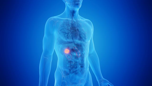 Medizinische Illustration eines menschlichen Körpers mit hervorgehobener Niere, die auf Nierenkrebs hinweist.