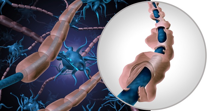 Myelinscheiden der Nerven bei Multipler Sklerose