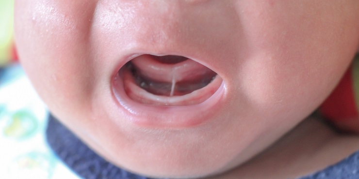 Zu kurzes Zungenband bei einem Baby