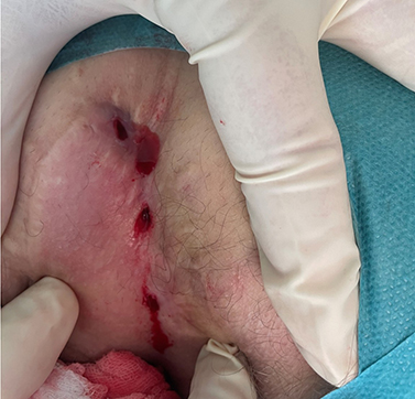 Nahaufnahme eines geöffneten Analabszesses während einer medizinischen Behandlung mit Latexhandschuhen.