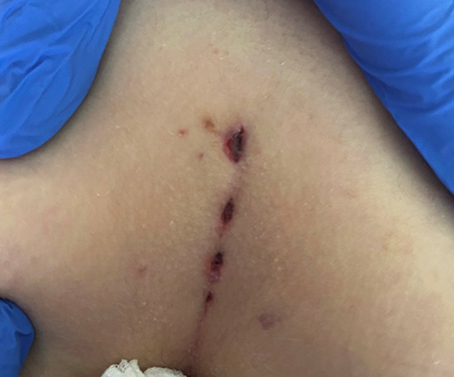 Postoperative Ansicht eines Analabszesses mit chirurgischen Einschnitten und blauen Handschuhen.