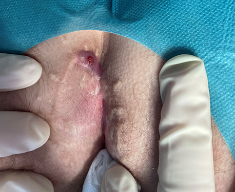 Nahaufnahme eines Analabszesses während einer medizinischen Untersuchung mit Handschuhen.