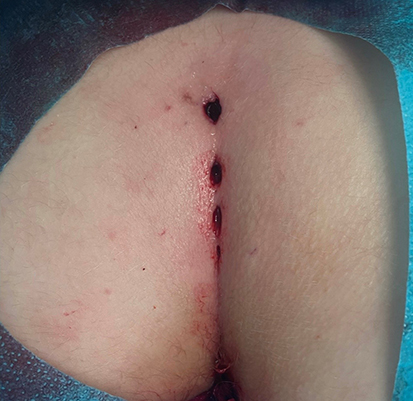 Postoperative Ansicht eines behandelten Analabszesses mit chirurgischen Einschnitten.