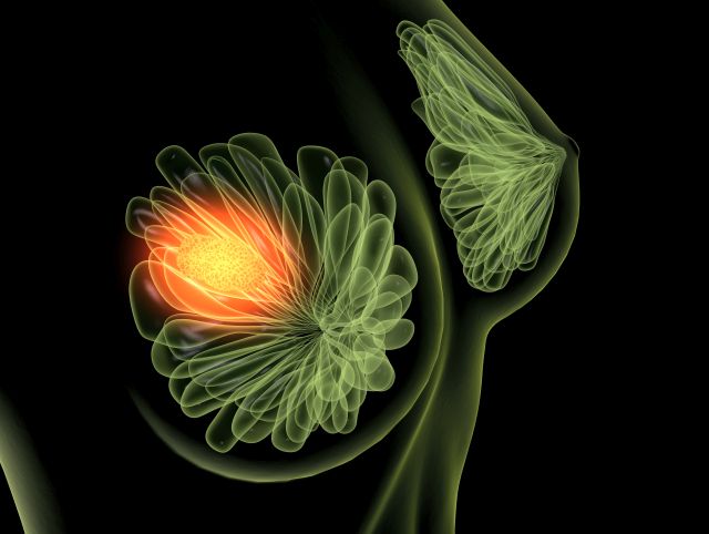 Medizinische Illustration einer weiblichen Brust mit hervorgehobenem Bereich zur Darstellung von Brustkrebs.