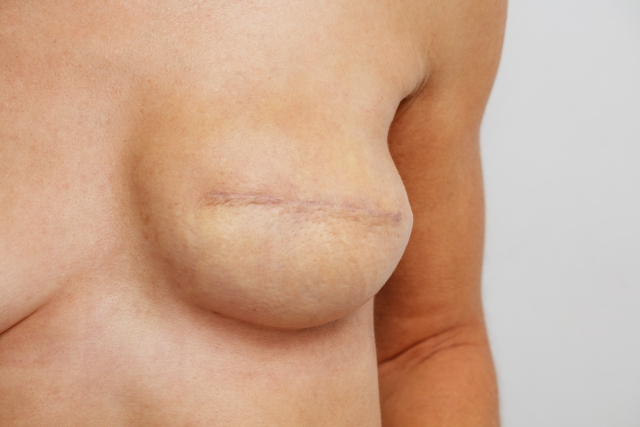 Postoperative Narbe nach Brustkrebsoperation mit Rekonstruktion