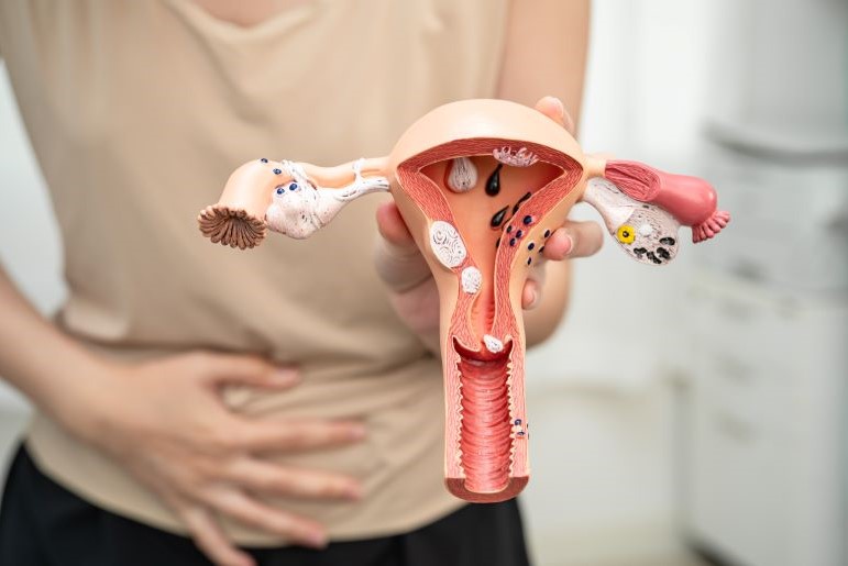 Anatomisches Modell der weiblichen Fortpflanzungsorgane zeigt Gebärmutter mit Endometritis-Entzündung.