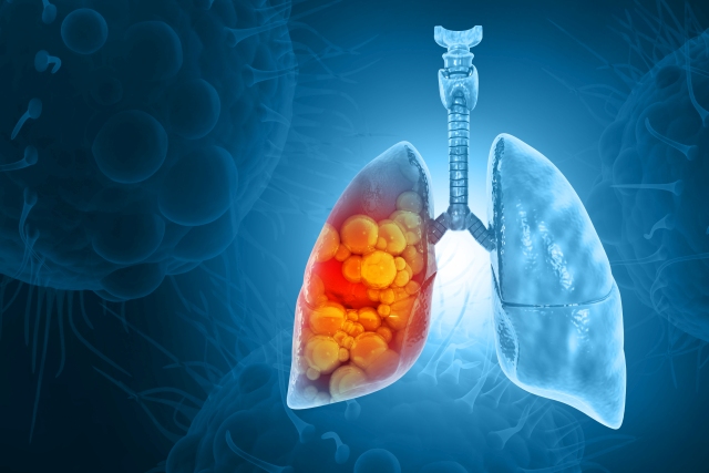 Darstellung eines Lungenkarzinoms mit Fokus auf die betroffenen Lungenbereiche bei fortgeschrittenem NSCLC.