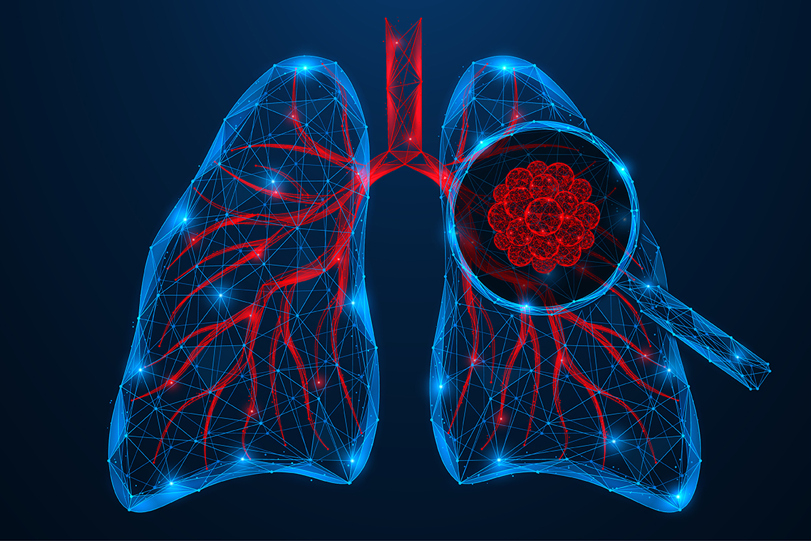 Stilisierte Darstellung der menschlichen Lunge mit Fokus auf Bronchien und Alveolen, verwendet zur Veranschaulichung von Lungenkrebsdiagnosen.